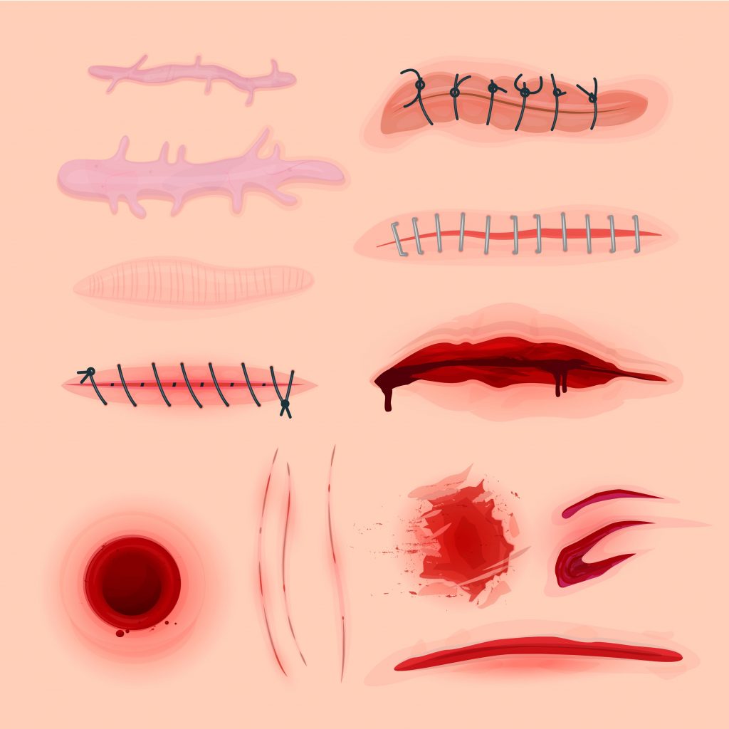Cicatrices